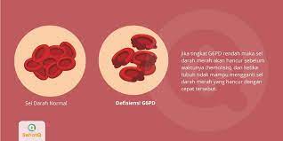 Check spelling or type a new query. Defisiensi Glukosa 6 Fosfat Dehidrogenase G6pd Tanda Dan Gejala Penyebab Cara Mengobati Cara Mencegah