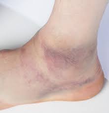 Banderdehnung Ursachen Beschwerden Therapie Gesundpedia De