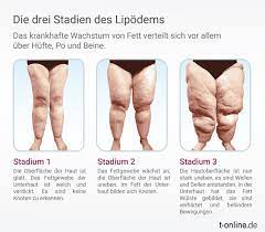 Lipodem Ursachen Behandlung Und Operation
