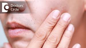 The size of the spots range petechiae are small red dots that appear when capillaries bleed and cause blood to leak into the skin. What Causes Red Dots On Face And Its Management Dr Nischal K Youtube