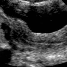 People were being brought from all sorts to of places to see if they had placenta praevia ( includ. Mixed Gonadal Dysgenesis Eurorad