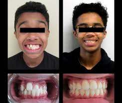 Frenos! Sin pago inicial $100 para empezar $100 por mes $2,000 en total -No  hay necesidad de seguro dental. -Sin necesidad de papeles -No hay necesidad  de puntuación de crédito! ¡Reclama esta