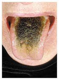 Hairy tongue is when the bumps on the tongue's surface get bigger, resulting in a rough texture, and a discolored and furry appearance. Woman Diagnosed With Hairy Black Tongue After Car Crash Nine Com Au
