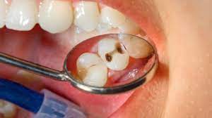Preventive Tips For Dental Caries 1 Brushing Your Teeth Twice A Day For At Least Two Minutes Using Fluori How To Prevent Cavities Dental Caries Dental Health