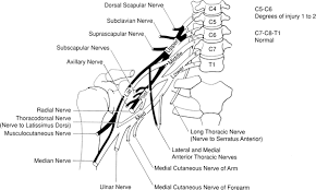 Brachial Plexus Injuries Peripheral Nerve Injuries