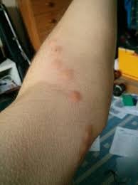 Fly bites can cause symptoms such as itching, redness, and swelling. Flea Bites Picture Of City View Hotel London Tripadvisor