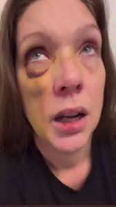 Holly’s bruises are healing but she says the aftermath of the concussions  has been tough to deal with. Here is her update in her own words. FOX19