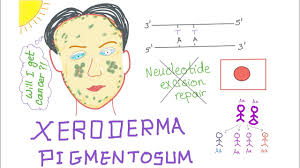 Precancerous lesions need to be. Xeroderma Pigmentosum Youtube