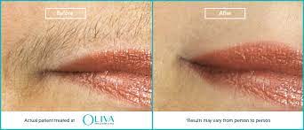Egg white mask for upper lip hair removal. How To Remove Unwanted Hair From Upper Lip Chin