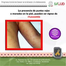 Check spelling or type a new query. Uzivatel Cancer Infantil Ssz Na Twitteru La Presencia De Puntos Rojos O Morados En La Piel Pueden Ser Signos De Leucemia Https T Co Jngn1eqk04