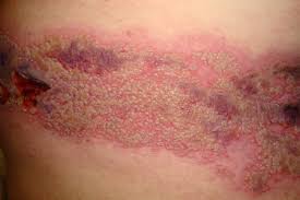 500 x 296 jpeg 38 кб. Fever And Rash Infectious Disease Advisor