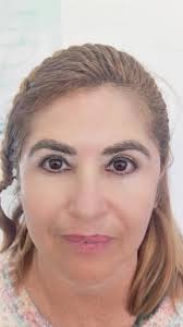 Acompáñanos en este recorrido ✨, Desde el antes de la cirugía  (blefaroplastia superior e inferior) hasta el resultado final: una mirada  más fresca, descansada y rejuvenecida. 👁️✨, Si estás pensando en ...