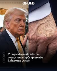 O presidente dos Estados Unidos, Donald Trump, foi diagnosticado com  insuficiência venosa crônica após se submeter a um exame médico devido a  inchaço nas pernas, informou nesta quinta-feira (17) a Casa Branca. ⁠ ⁠
