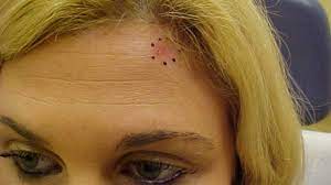 Mark lebwohl, md, a professor and the chairman at the kimberly and eric j. I Was Only 28 When I Was Diagnosed With Skin Cancer Here S What I Want You To Know Huffpost Life