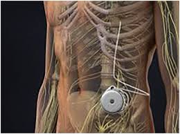 Image result for Intrathecal Pump