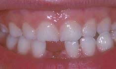 Gum Disease
