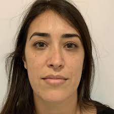 2 months after revision rhinoplasty, from Israel 🇮🇱 👉  #revisionrhinoplasty @drahmetalp.israelassistant  #revisionrhinoplastyspecialist #revisionrhinoplastyexpert #nosejob #noseart  #nasenkorrektur #rinoplastica #rinoplastia #rhinoplasty #drahmetalp ...