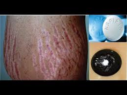Get Rid Of Stretch Marks Very Fast Using Aspirin Youtube Stretch Marks How To Remove Pimples Home Remedies For Pimples
