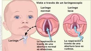 With inspiration (breathing in), the tissues above the vocal cords fall in towards the airway and cause partial obstruction. Http Www Saludinfantil Org Seminarios Neo Seminarios Broncopulmonar Estridor Neonatal Pdf