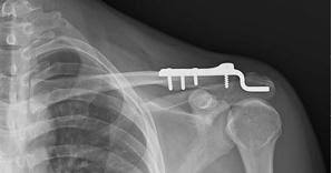 Maybe you would like to learn more about one of these? Acromioclavicular Joint Injury Shoulder Elbow Orthobullets