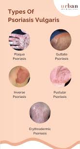 Image result for psoriasis