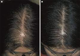 The adrenal glands in women are responsible for the production of the testosterone. Christmas Tree Pattern Of Hair Loss Shows Moderate Improvement Compared Download Scientific Diagram