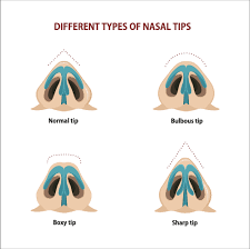This type of nose has the downward pointing tip, and the bridge of it always remains straight and rigid. A Complete Guide To Wide Nose Rhinoplasty Nose Jobs For Wide Noses