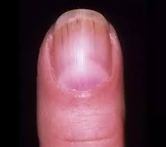 To understand what a nail bed is, it is best to first have an idea of the function and anatomy of the entire nail. Why Does A Brown Line Appear On A Fingernail Quora