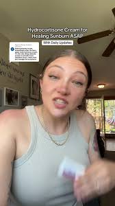 Effective Sunburn Relief Tips for Wedding Week