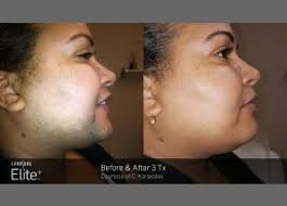 Women grow facial hair differently than men because they lack testosterone. Laser Hair Removal Denver Co Long Term Hair Removal Foxy Laser