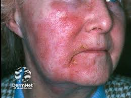 Image result for dermatitis contacta allergica