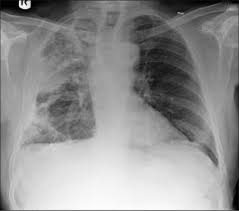While it can be helpful, there are also risks. Pleural Mesothelioma Pleural Cancer Sleep And Lung Care