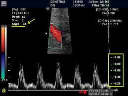 Doppler Ultrasound Principles And Practice