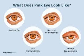 Image result for Allergic Conjunctivitis