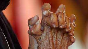 The acronym lepra stands for the leprosy relief association. Die Unheimliche Krankheit Lepra Lebt Sn At