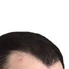 haartransplantation pickel an der tagesordnung haartransplantation haare pickel