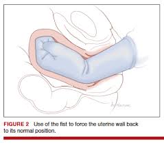 Image result for Retained Placenta