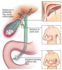 La sua vescica è forse più piccola della tua. Cholecystitis Guide Causes Symptoms And Treatment Options