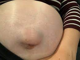 Does Anyone Have An Umbilical Hernia January 2019 Babies Forums What To Expect