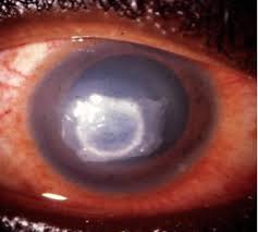 .keratitis and/or disciform stromal scarring (44) as well as ulcerative necrotizing stromal keratitis (7) were processed for herpes simplex virus (hsv) antigens using an immunoperoxidase technique and. When Herpes Simplex Won T Go Away