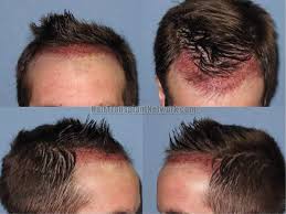 We offer free consultations to those concerned about losing their hair, wanting to learn more about hair loss and those interested in finding a hair restoration solution. How Much Is Bosley Hair Surgery
