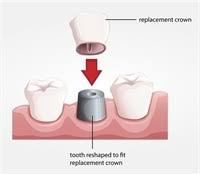 It just takes ages to do. Procedure For Dental Crowns