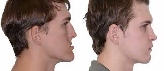 Does the numbness of a low jaw surgery ever completely go away?