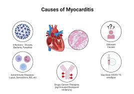 Image result for Myocarditis