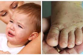 Image result for scabies human children