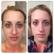 Will drinking more water improve your skin? She Drank One Gallon Of Water A Day And Look What Happened No Excuse Mom