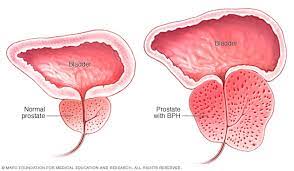 Interstitial laser coagulation versus transurethral prostate resection for treating benign prostatic obstruction: Transurethral Resection Of The Prostate Turp Mayo Clinic