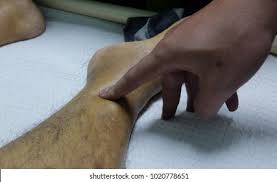 Image result for Edema Exam