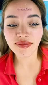 Fillers labiales•🫦💉, ✨AUMENTÓ DE LABIOS SIN CIRUGÍA✨🫶🏻💖, ✨Con este  revolucionario método no quirúrgico, se logra dar volumen, hidratación y  aumento de los labios, dejando un efecto natural., Se coloca ...