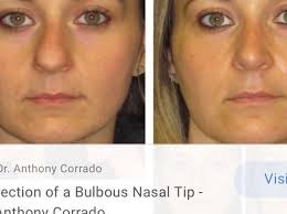Taking a hot shower or using a humidifier are some easy ways to. Scared To Get A Nose Job Because I Have A Bulbous Nose Is There Any Procedure Method To Prevent A Round Undefined Nose Photo